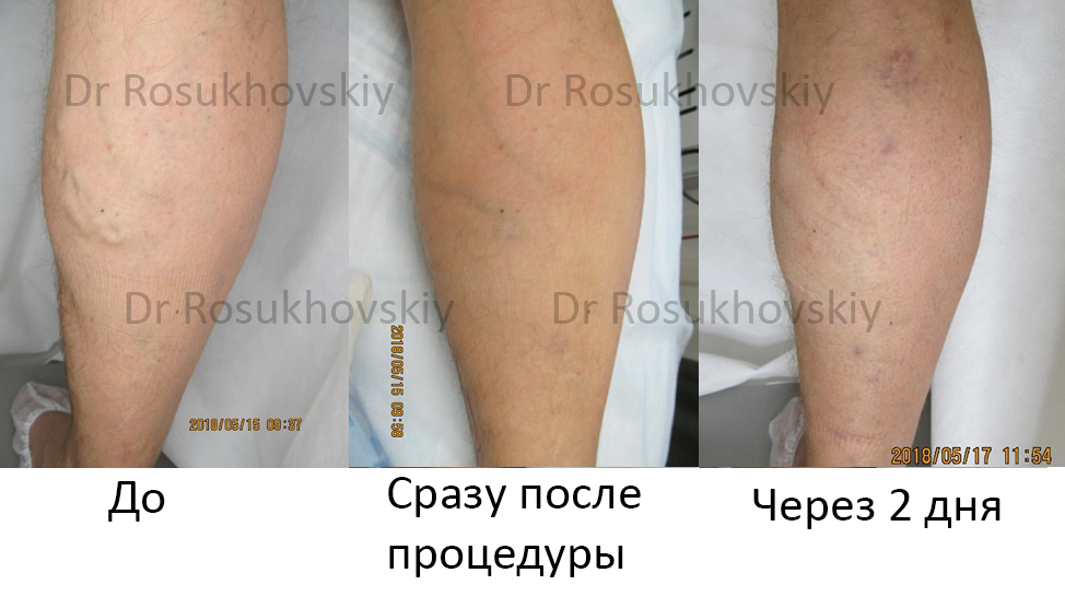 ЭВЛК фото до и после. Лечение варикоза без операции.